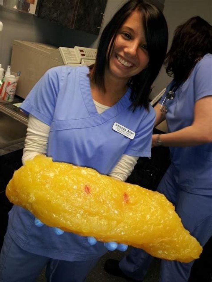 20 Pounds Of Fat Look Like
