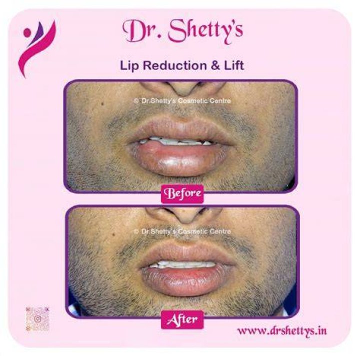 5 Best Lip Reshaping Apps How to Edit Cupid&rsquo;s Bow on Photo PERFECT