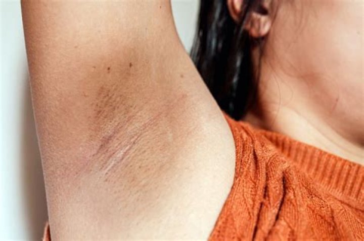 6 causes of underarm rashes and how to avoid irritating your armpits