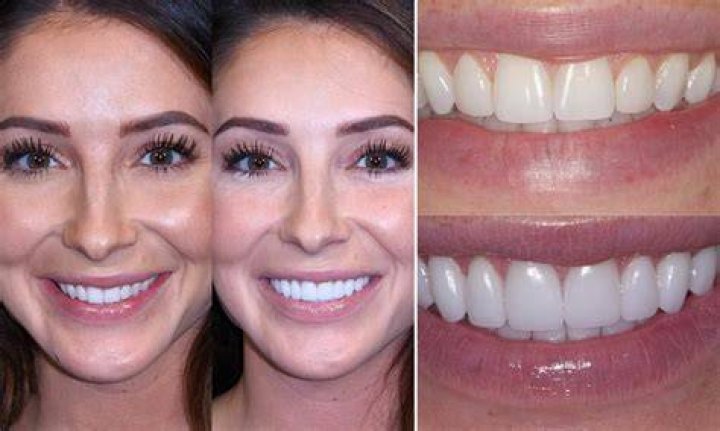 Anthony Davis Teeth Fixed Before And After TeethWalls