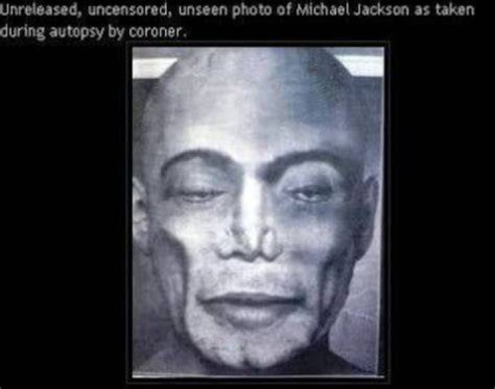 Autopsy photograph of Michael Jackson. MEDizzy