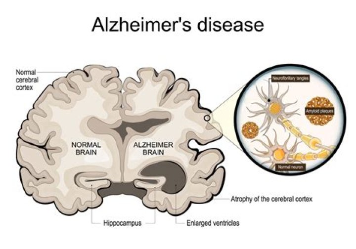 Daniel Boone Star Illness And Alzheimer Disease ·