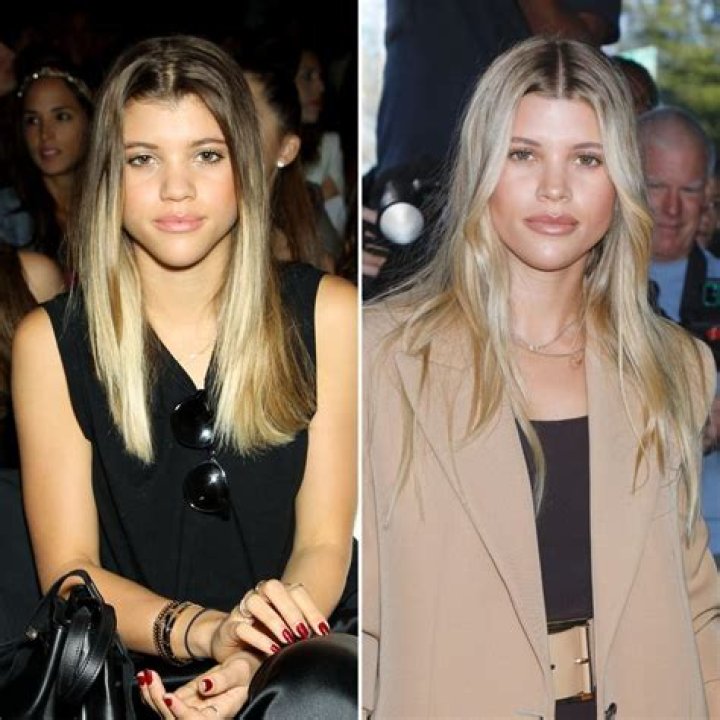 Did Sofia Richie Get a Nose Job? Plastic Surgery Photos