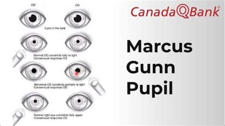 EyeKids Síndrome de Marcus Gunn o que é, por que a pálpebra abre