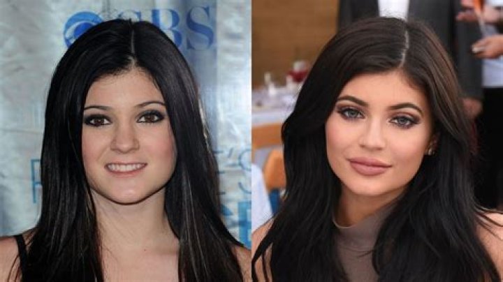 Fans shocked by changing face of Kylie Jenner NZ Herald
