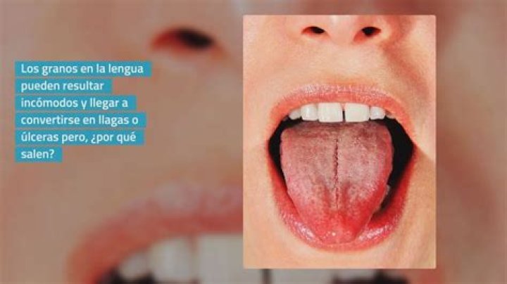 Granos En La Lengua Fotos