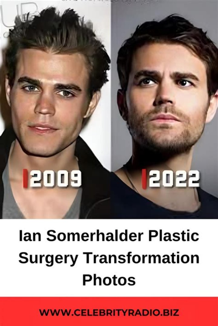 Ian Somerhalder's Plastic Surgery Journey