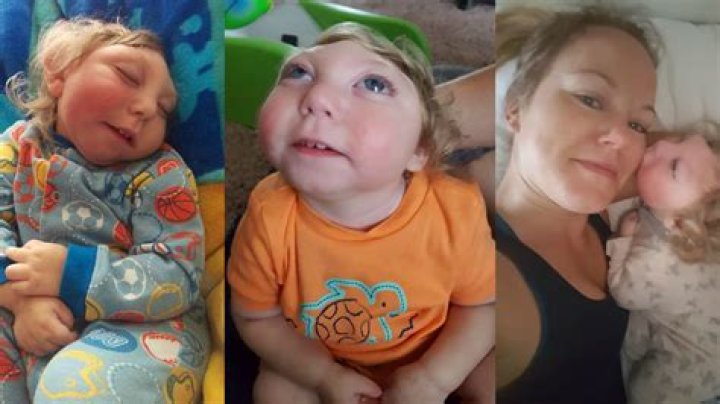 Jaxon Strong, Miracle Baby Born With Most of His Skull Missing, Just