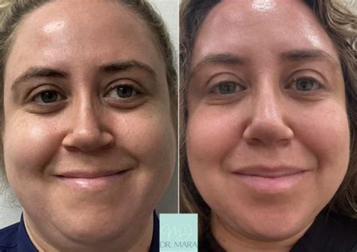 Jelly Roll Botox Is Trending—Here's What You Should Know Marie Claire UK
