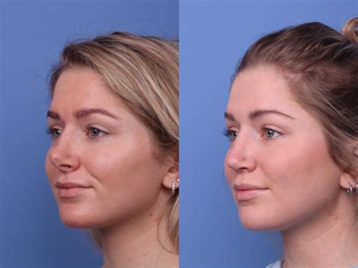 Jenna Fischer Plastic Surgery Before and After