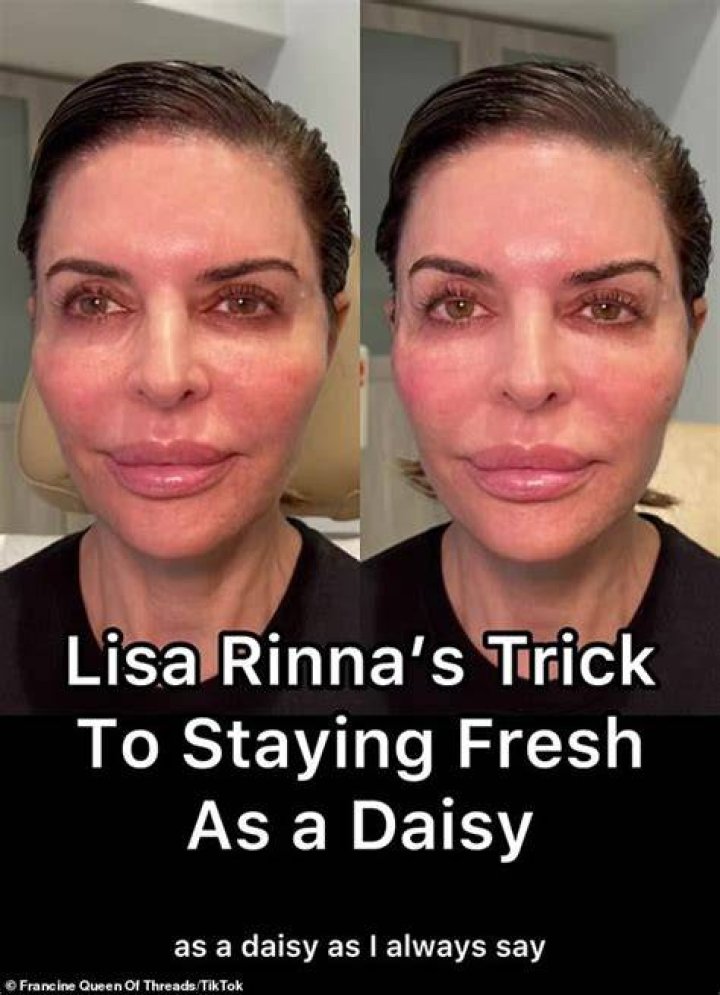 Lisa Rinna's Plastic Surgery Explained |