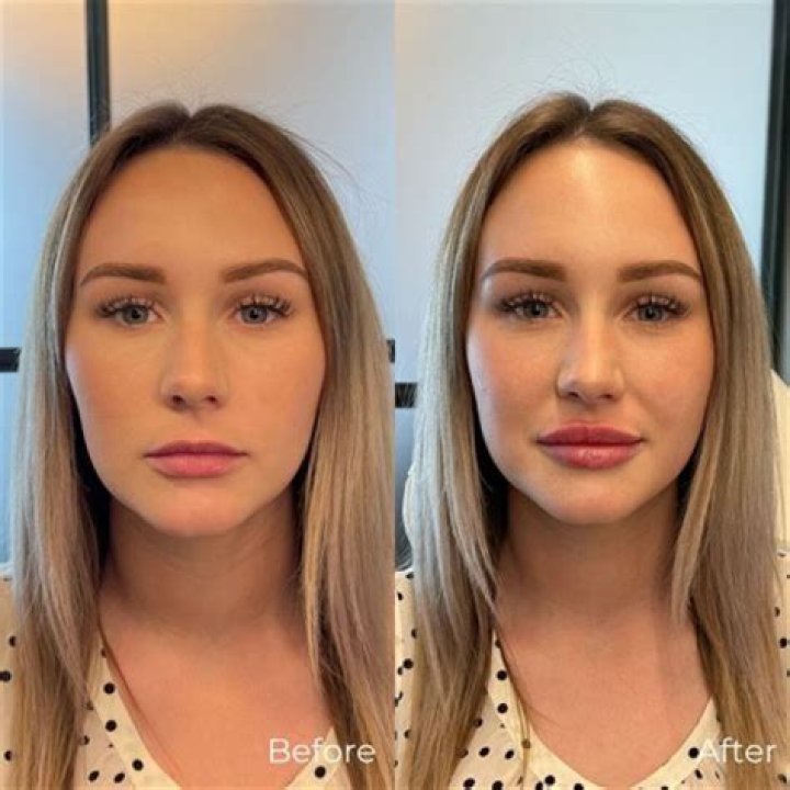 Mackenzie Ziegler Nose Job Botox And Filler Before And After