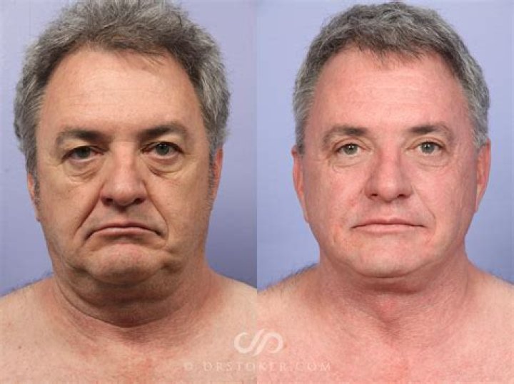 Male plastic surgery gone awry