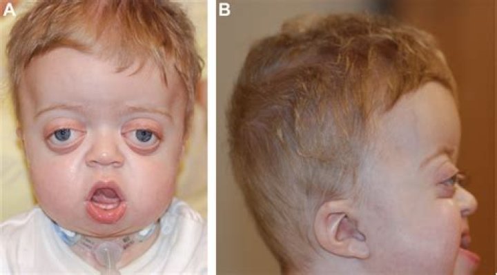 mason renner obituary and pfeiffer syndrome