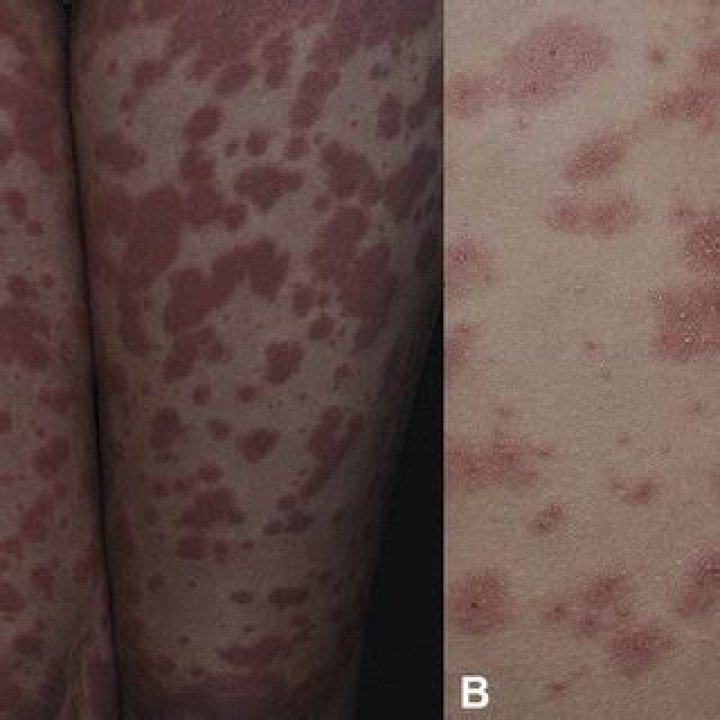 Multiple diffuse erythematous maculopatches studded with several