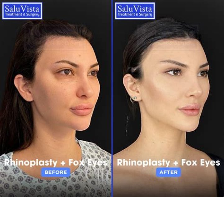 New 30minute fox eye treatment at noon that lifts the eyebrows with