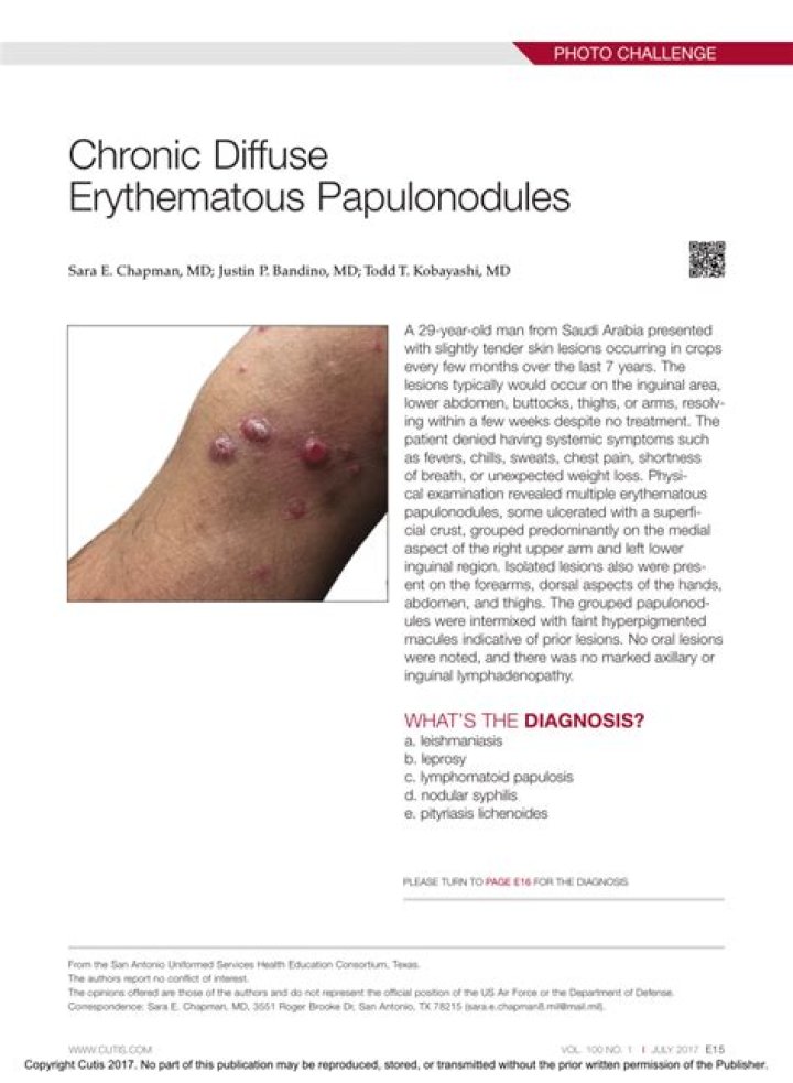 (PDF) Chronic Diffuse Erythematous Papulonodules