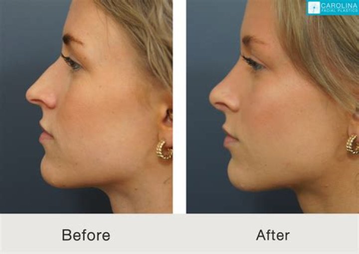 Rhinoplasty before and after Which celebs have had nose jobs from