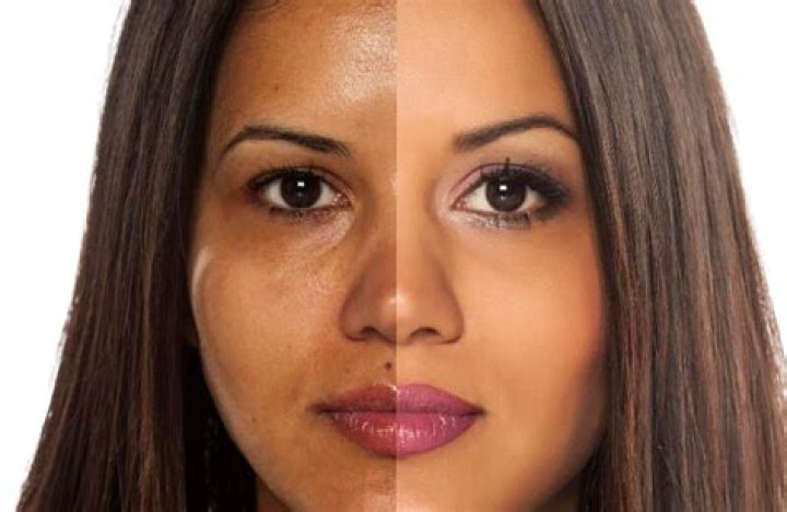 Skin Bleaching Gone Wrong