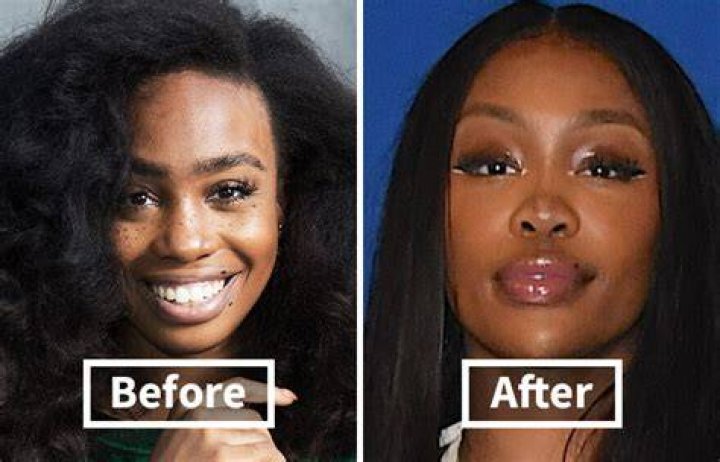 SZA Before Plastic Surgery. Introduction by Surgical Tech Medium