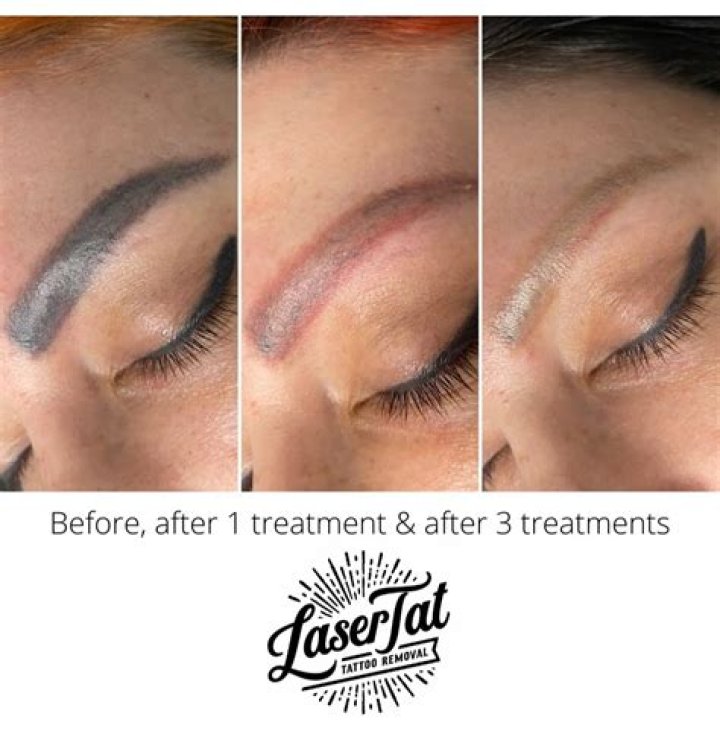 Tattoo Removal Treatment Treatment