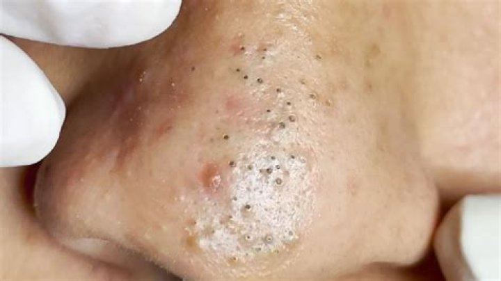 This ear-blackhead removal is so satisfying it has an instant replay