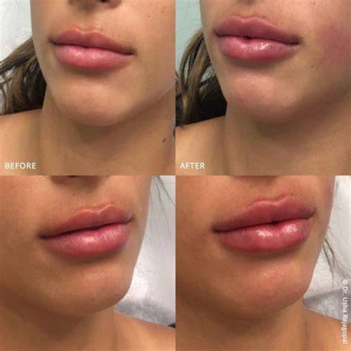 Too much lip filler with a botox lip flip. Luckily it will fade away