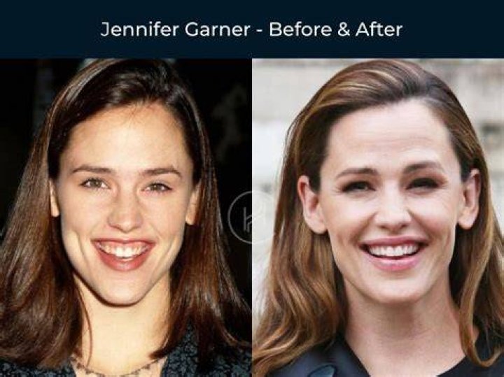 Top 21 Celebrities Before and After Veneers And Cosmetic Dentistry