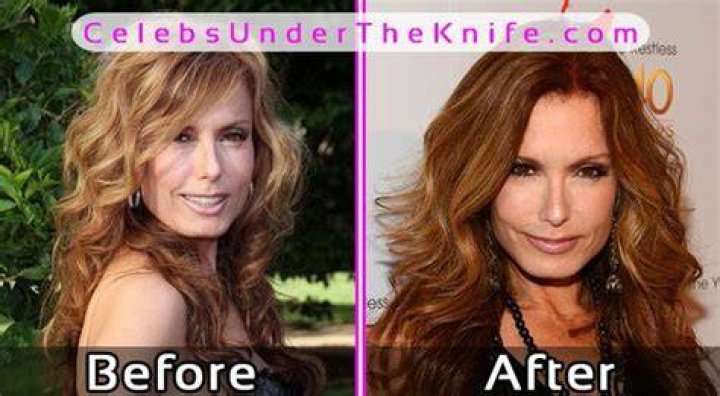 Tracey Bregman Plastic Surgery, Illness, Bio, Wiki, Age, Career