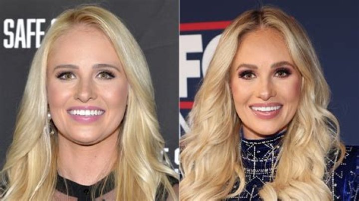 Unveiling The Truth: Tomi Lahren And Plastic Surgery