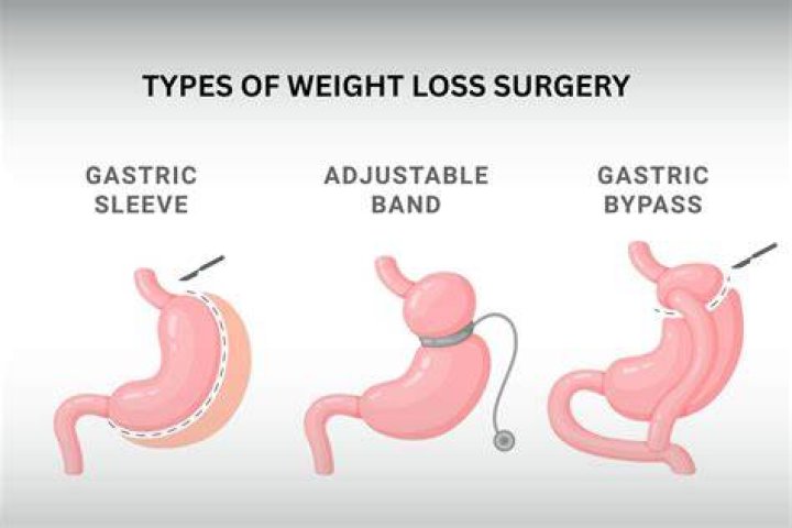 Weight Loss Surgery, Gypsy-lupone