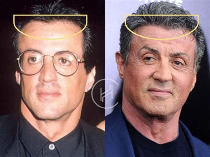 What Happened To Sylvester Stallone's Face -Partial Paralysis And Health