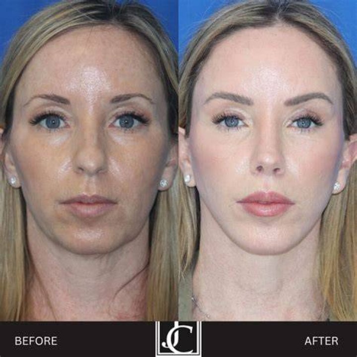 What is a Midface Lift & Fox Eye Surgery? Dr. Mark Plastic Surgery