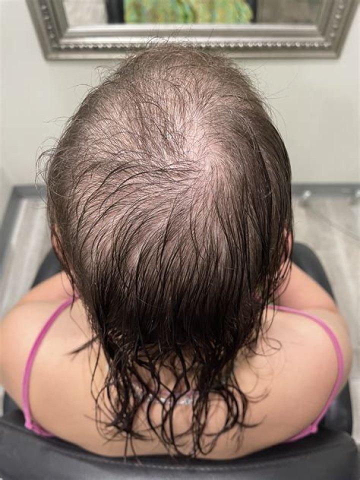 Why is Rylee Langerman Arkansas Bald From Hair Loss? Cancer Or Alopecia